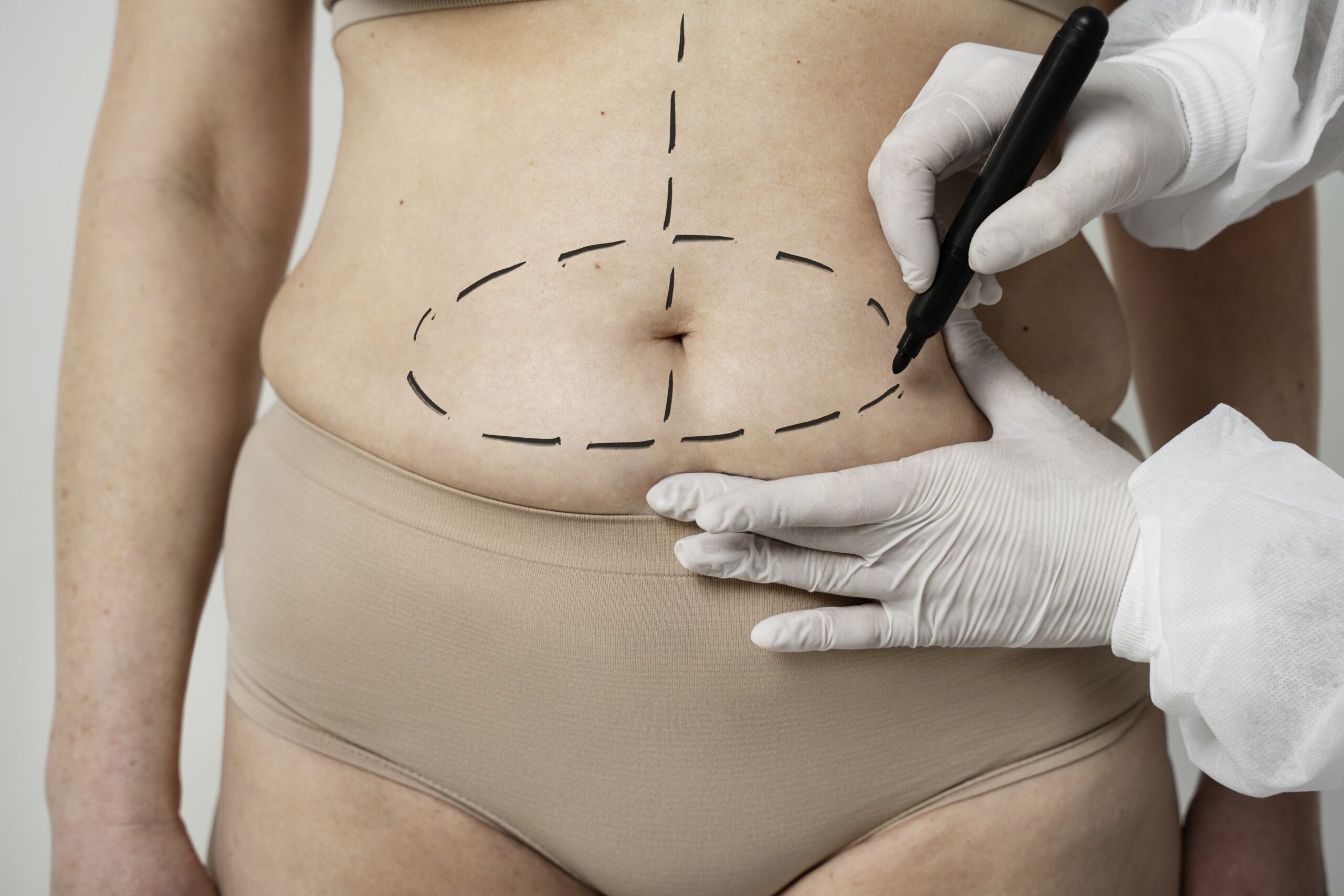 Preguntas Frecuentes sobre Abdominoplastia en Medellín Preguntas frecuentes sobre abdominoplastia con el Dr. Luis Guillermo Tobón, cirujano plástico en Medellín