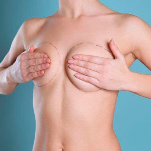 Preservé™ paso a paso: así realizo tu cirugía de aumento mamario