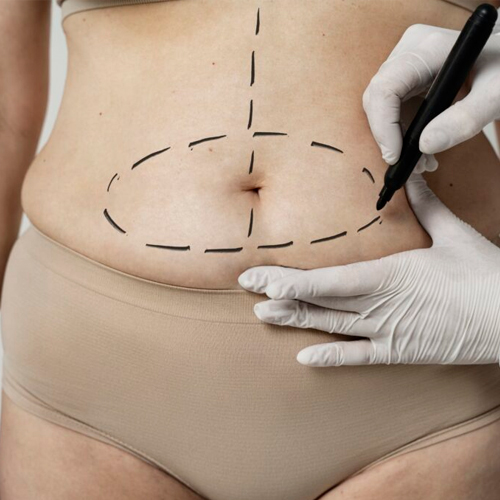 Preguntas frecuentes acerca de la Abdominoplastia